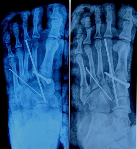 Lisfranc Fracture The Foot And Ankle Online Journal