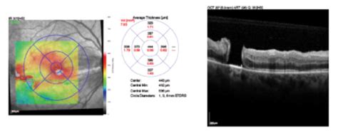 Epiretinal Membrane Surgery: To Peel or Not to Peel the ILM? - Retina Today