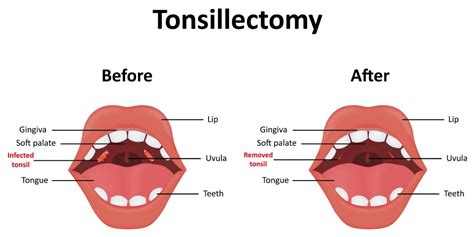 A Complete Guide To Tonsillectomy Pristyn Care