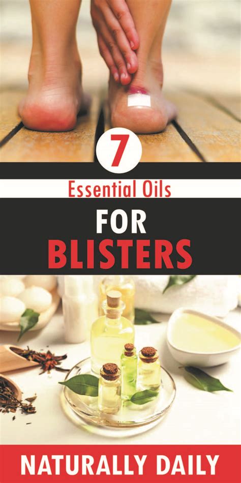 Blisters - Essential Oils NZ and Natural Pigmentation Skincare | Beauty ...
