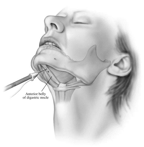 Botulinum Toxin Injections For The Treatment Of Oromandibular Dystonia Operative Techniques In