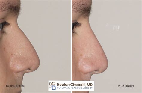 Augmentation Rhinoplasty Without Breaking The Nose