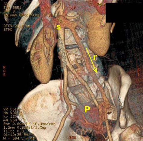 Pelvic Congestion Syndrome I Josef Pflug Vascular Laboratory