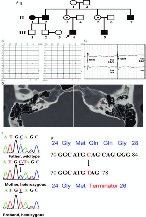 The Clinical Features Of The Proband And Mutation Analysis A