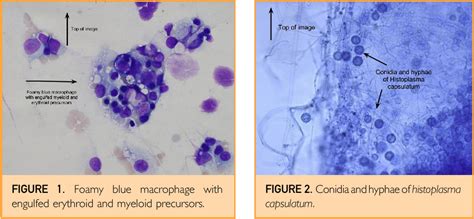 Figure 1 From Disseminated Histoplasmosis A Cause Of Hemophagocytic Syndrome Semantic Scholar