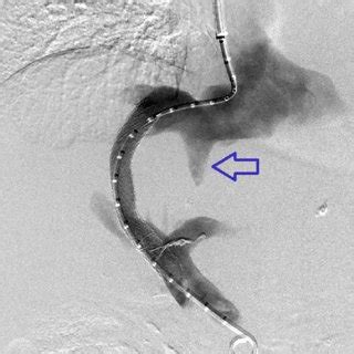 E Portal Venogram Demonstrating Patency Of The Intraparenchymal Tract