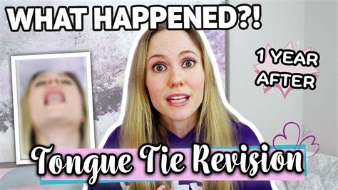 Adult Tongue Tie Release Update What Happened Youtube