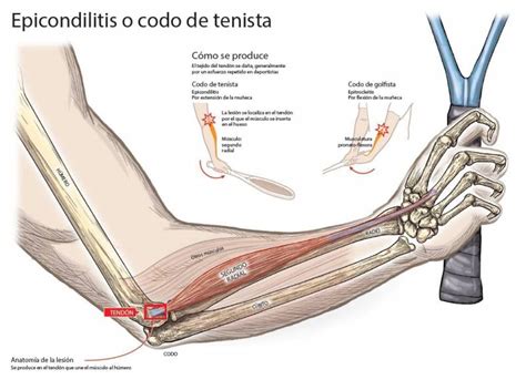 Codo Del Tenista Causas Y Tratamiento