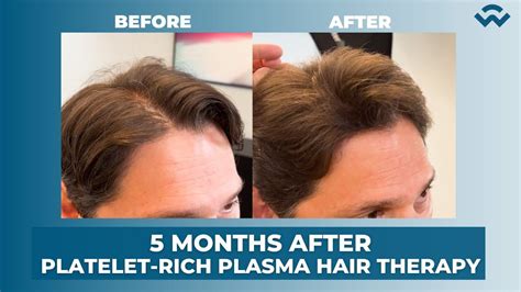 Bob Jarosinskis Hair Growth Results After 3 Enhanced Plasma Therapy