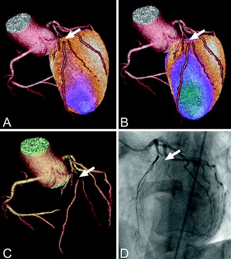 Cardiac Hybrid Imaging With High Speed Single Photon Emission Computed