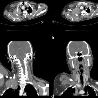 Preoperative Contrast Enhanced Computed Tomography Angiogram CTA A