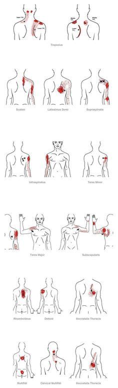 8 Muscle Knots ideas | trigger points, trigger point therapy, massage ...