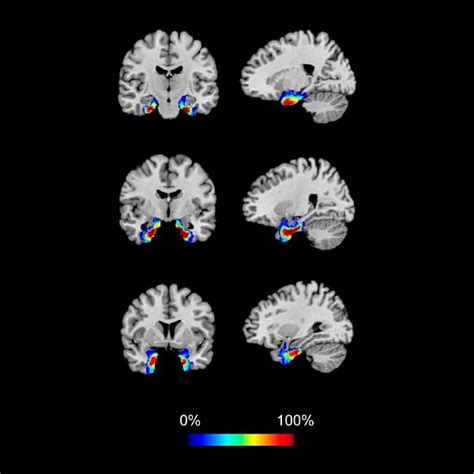 Parahippocampal Gyrus (Areas 28, 34, 35, 36) | Radiology Key