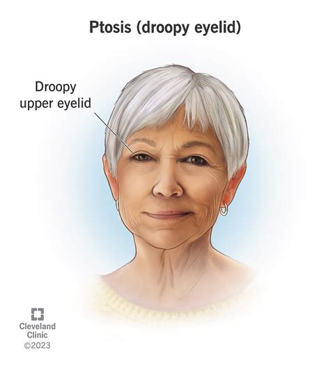 Ptosis (Droopy Eyelid): Causes & Treatment