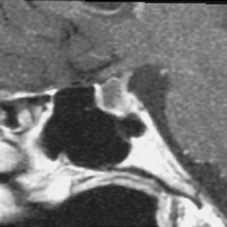 Sagittal MRI of patient 20 years later noting return of the Rathke's... | Download Scientific ...