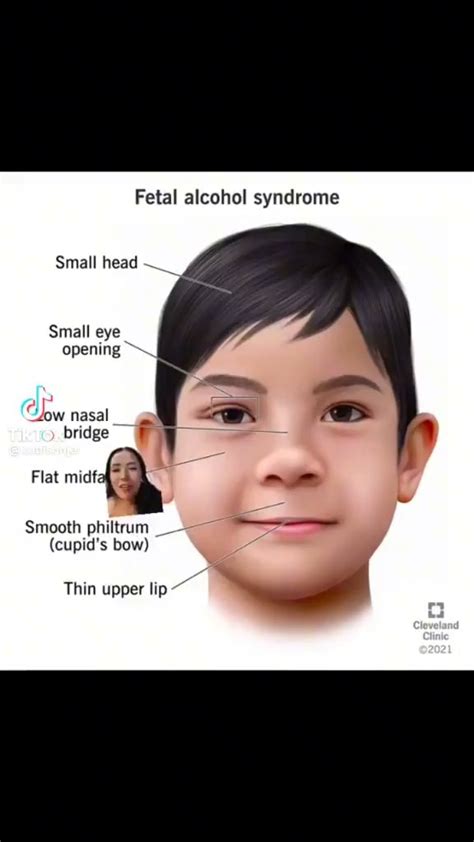 Fetal Alcohol Syndrome Small Head Small Eye Opening Jow Nasal Bridge