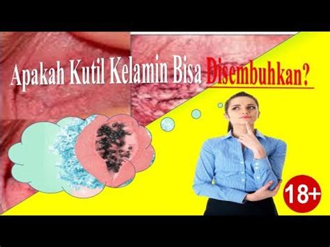 Apakah Kutil Kelamin Bisa Disembuhkan Youtube