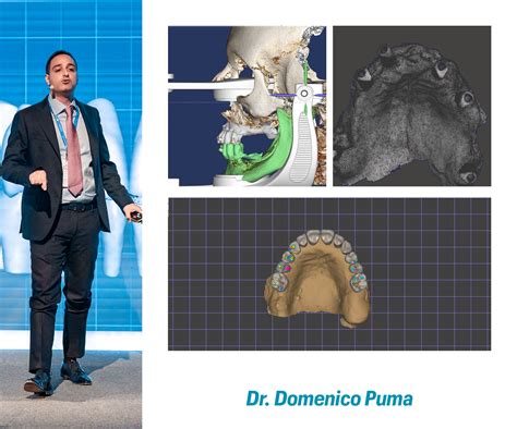 PROTOCOLLO FULL DIGITAL NELL IMPLANTOLOGIA A CARICO IMMEDIATO CON