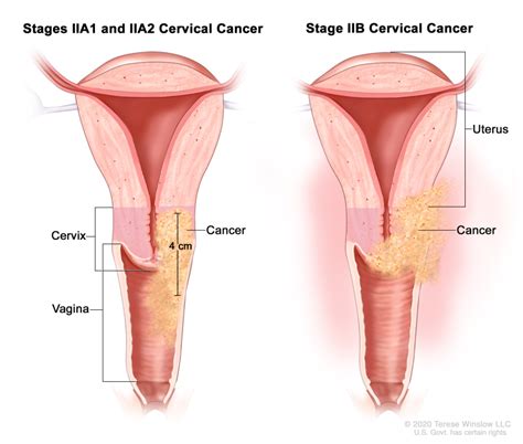 Cervical Cancer Treatment Pdq® Pdq Cancer Information Summaries