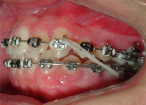 Class Ii Elastic Intermaxillary Treatment Download Scientific Diagram