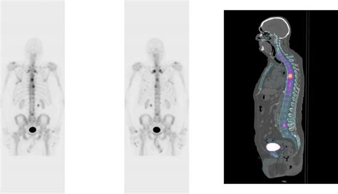 Nuclear Medicine Studies: Whole-Body Bone SPECT-CT Scans For Cancer ...