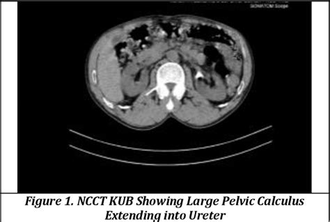 Figure 1 from ROLE OF MINI PCNL IN THE TREATMENT OF RENAL AND UPPER ...