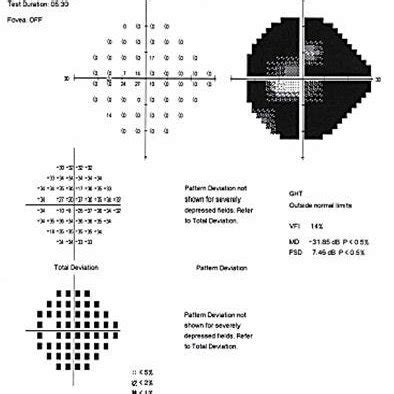 Humphrey Visual Field Of The Left Eye At Presentation Showing An