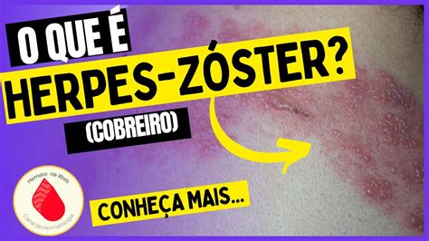 HERPES ZÓSTER COBREIRO O que é isso Geydson Cruz MD MSc YouTube