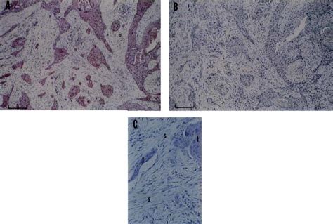 Immunohistochemical Localization Of Mmp 9 In Resected Sccoc