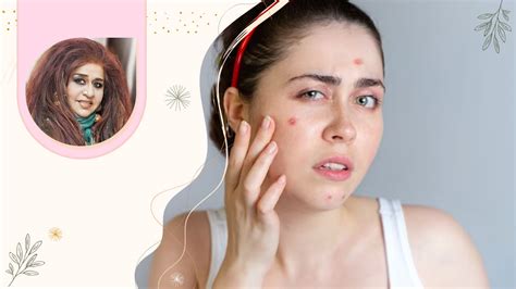 शहनाज हुसैन से जानें Teenage में कैसे कंट्रोल करें एक्ने How To