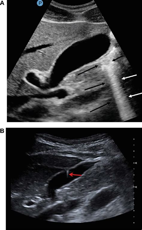 Figure 2 From Artifacts In Diagnostic Ultrasound Semantic Scholar