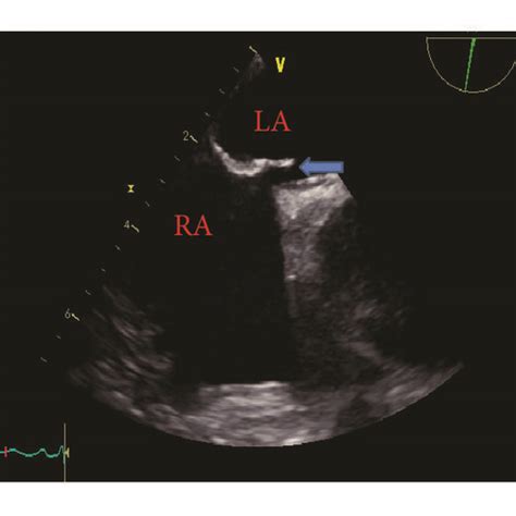 Transesophageal Echocardiography Demonstrating The Interatrial Septum