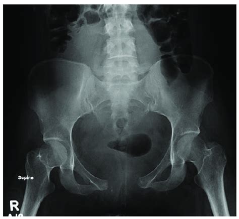 Initial Ap Pelvis Radiograph On Presentation Demonstrating A 50 Cm