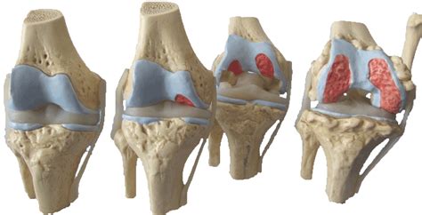 Tratamento Viscobiológico sem cirurgia para Artrose e Artrite de