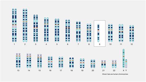 Monosomy