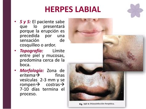 Molusco Contagioso Herpes Virus Y Queratolisis Plantar Dermatología