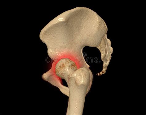 Escándalo Cónico Del Hueso Pélvico Y De La Articulación De Cadera 3d