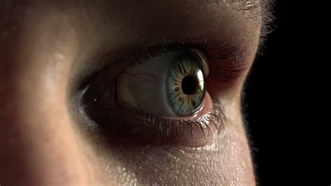 Blepharophimosis Syndrome: Causes, Symptoms, Diagnosis, Treatment, and ...