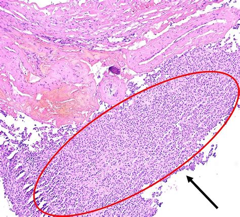 Histopathological Examination Showed Plump Small Round Cells He Download Scientific Diagram