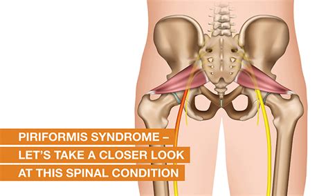 Piriformis Syndrome Treatment Causes And Symptoms Qi Spine