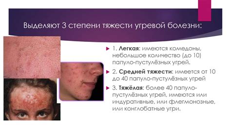 Угревая болезнь - презентация онлайн