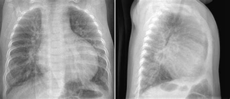 Pulmonary Vascularity Radiology Key