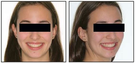 Bracket Positioning For Smile Arc Protection Jco Online Journal Of