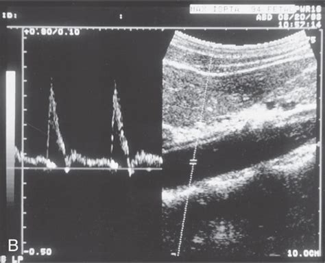 Doppler Flow Patterns In The Abdominal Arteries Flashcards Quizlet