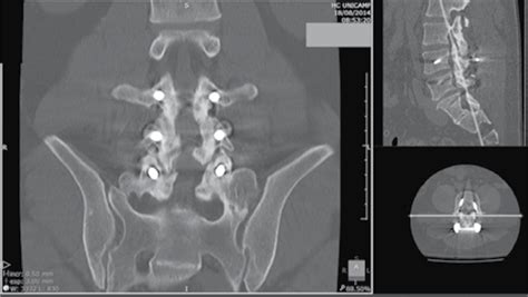 Scielo Brasil Reproducibility Of Tomographic Evaluation Of