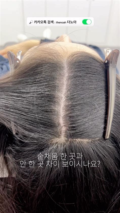 비싼 비용으로 모발이식 하지마세요 🙅🏻‍♀️ 더노아 그라 숱채움을 하면 거의 모발이식 수준으로 드라마틱하게 변하실 수 있어요