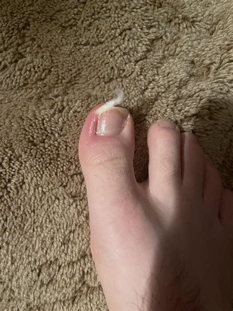 Partial Toenail Removal