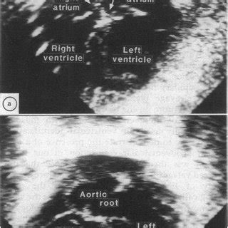 Cross Sectional Echocardiograms From A Patient With Ebstein S