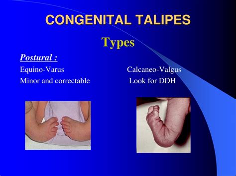 Ppt Congenital Clubfoot Congenital Talipes Equino Varus Powerpoint Presentation Id9549173