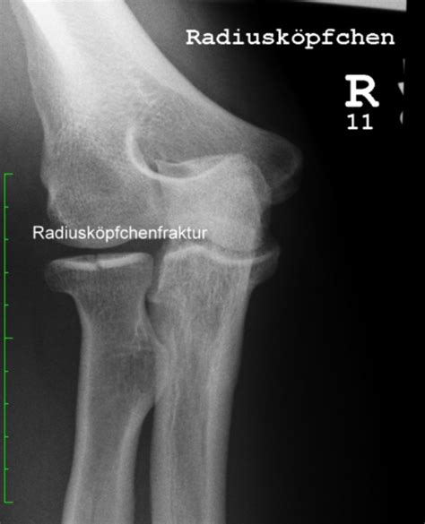 Radiusköpfchenfraktur DocCheck